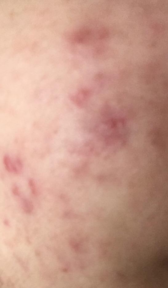 Zoretanin - Roaccutane kullanan var mı?
