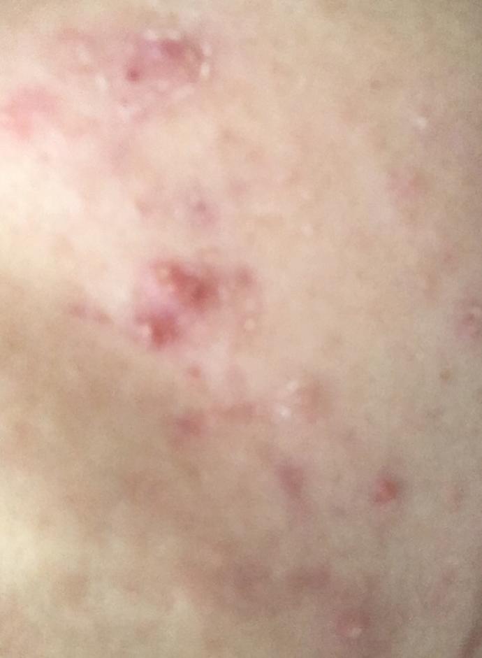 Zoretanin - Roaccutane kullanan var mı?