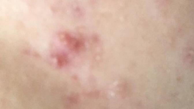 Zoretanin - Roaccutane kullanan var mı?