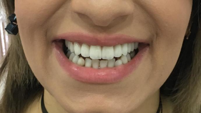 Zirkonyum porselen kaplama yaptırdım, nasıl olmuş?