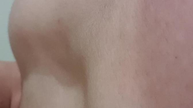 Sevgilinizin böyle bir göğüs bozukluğu olsa ne hissedersiniz?