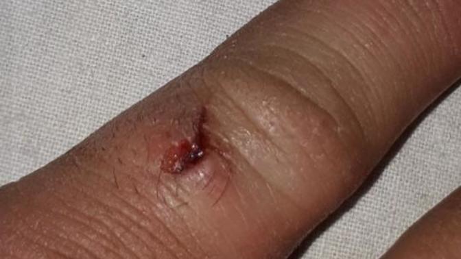 Serçe parmağıma cam battı ve sonra şişti?
