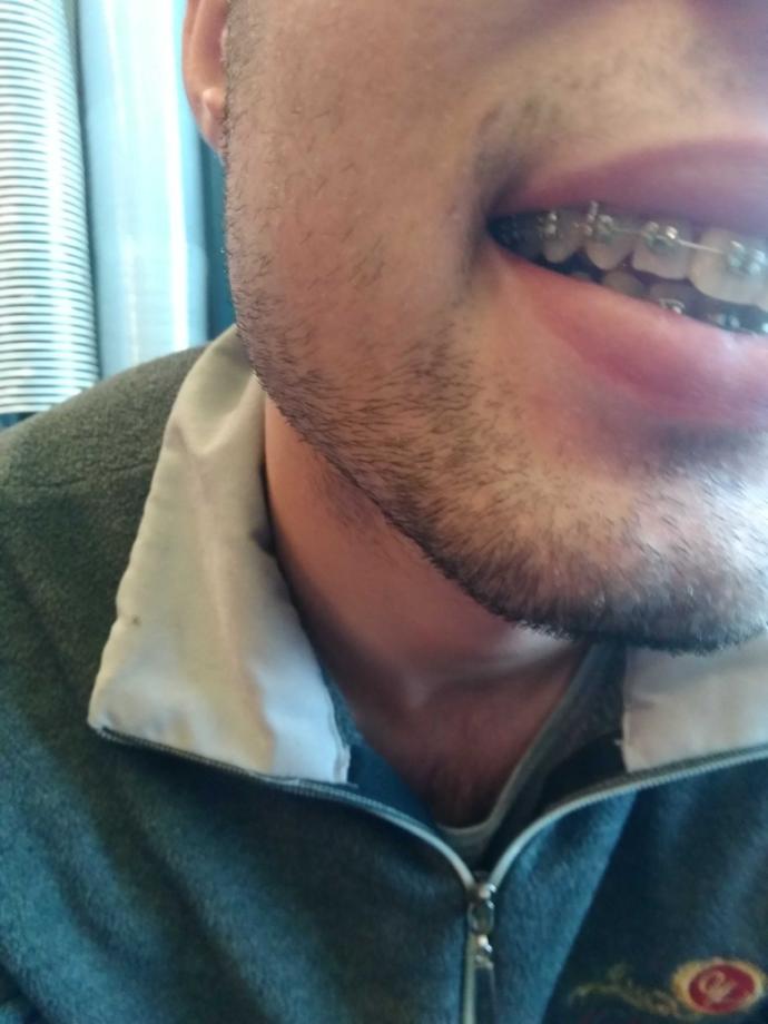 Dışım brakete değiyor diye dışımın tekini törpüledi doktor bana sormadan normal mi?