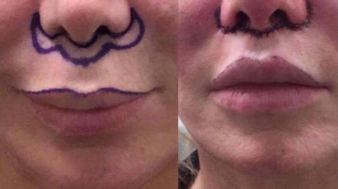 Lip lift ameliyatı Olan var mı?