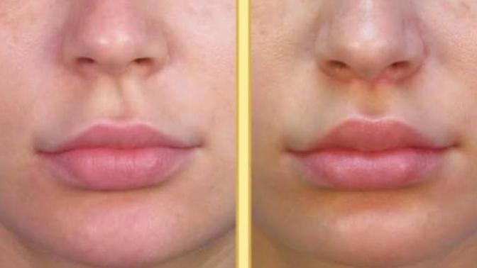 Lip lift ameliyatı Olan var mı?