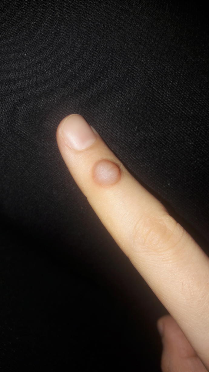 Parmağımda böyle bir şişlik çıktı nasıl geçer?