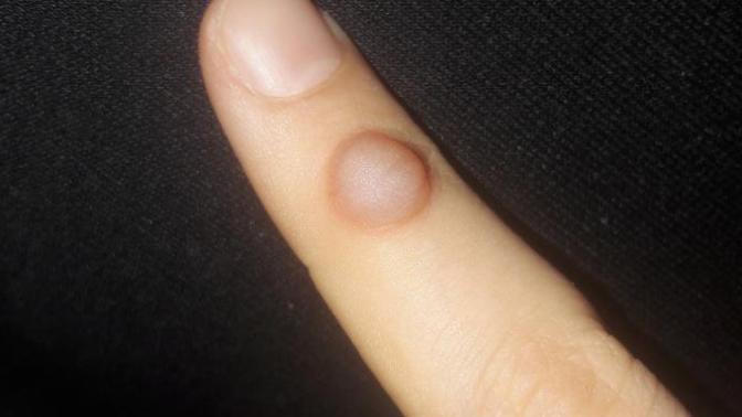 Parmağımda böyle  bir  şişlik çıktı nasıl geçer?