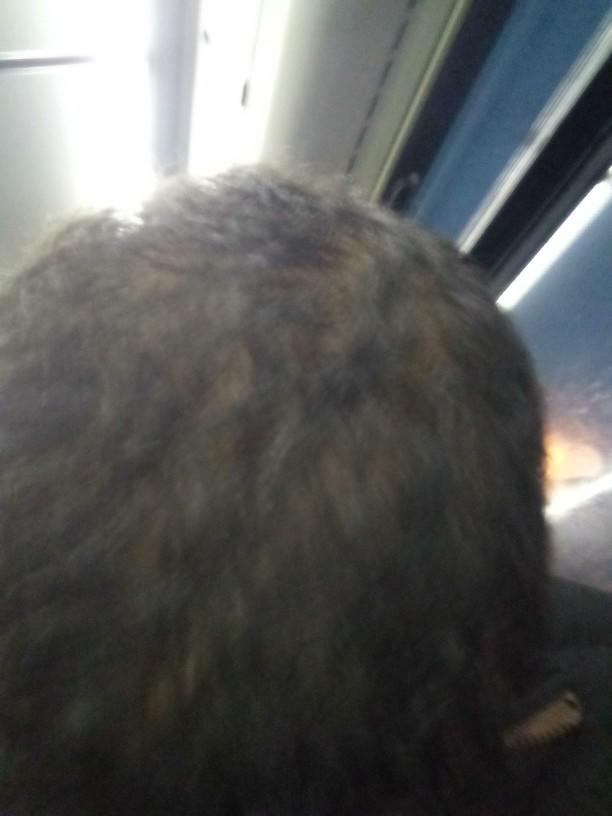 Saçlarım cok seyrek 18 yaşındayım ne yapmalıyım?