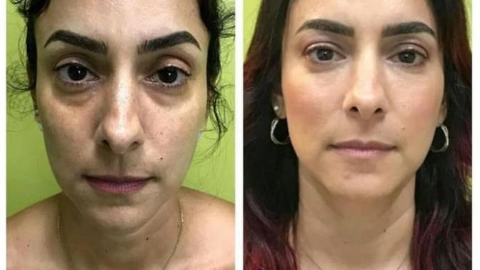 Gözaltı ışık dolgusu yaptıran?