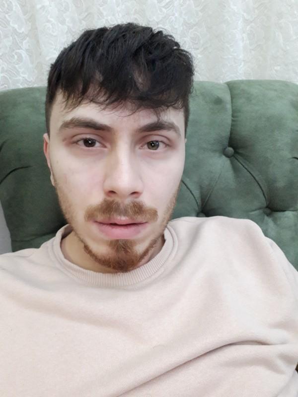 Aranız'da Heterokromi hastası varmı?