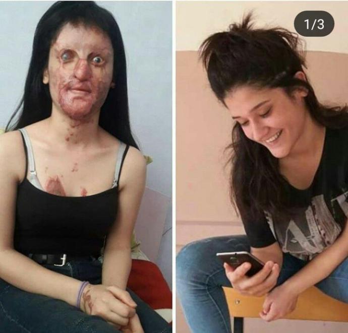 Ayrılmak istediği için sevgilisinin yüzüne asit döken mahlukatın cezası ne olmalı?