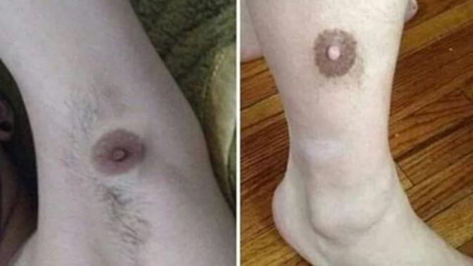Sevgilimin bacaginda ve koltuk altinda bir şey buldum. Ne bu?