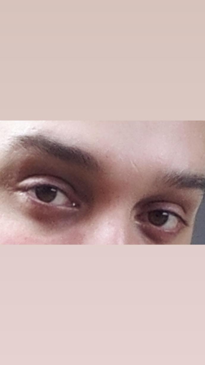 Üst göz kapaklarımdan estetik ameliyat olmalı mıyım?