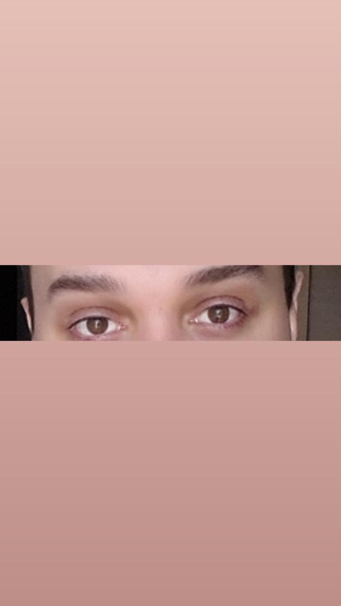 Üst göz kapaklarımdan estetik ameliyat olmalı mıyım?