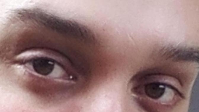 Üst göz kapaklarımdan estetik ameliyat olmalı mıyım?