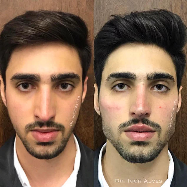 Oval yüzlüyüm, çenem bebek çenesi gibi çok mu kötü bir şey?