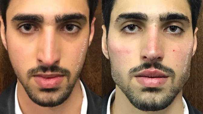 Oval yüzlüyüm, çenem bebek çenesi gibi çok mu kötü bir şey?