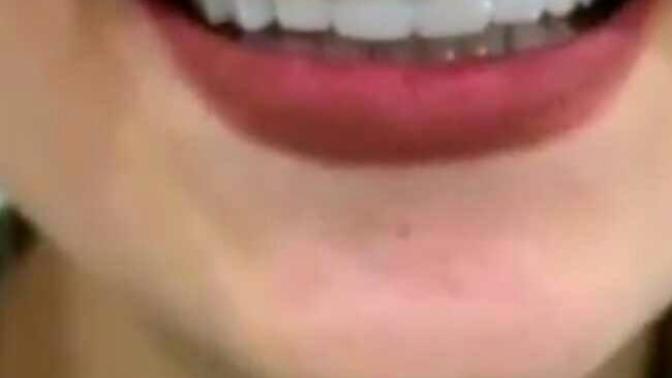 Diş kaplama yaptım nasıl olmuş? 