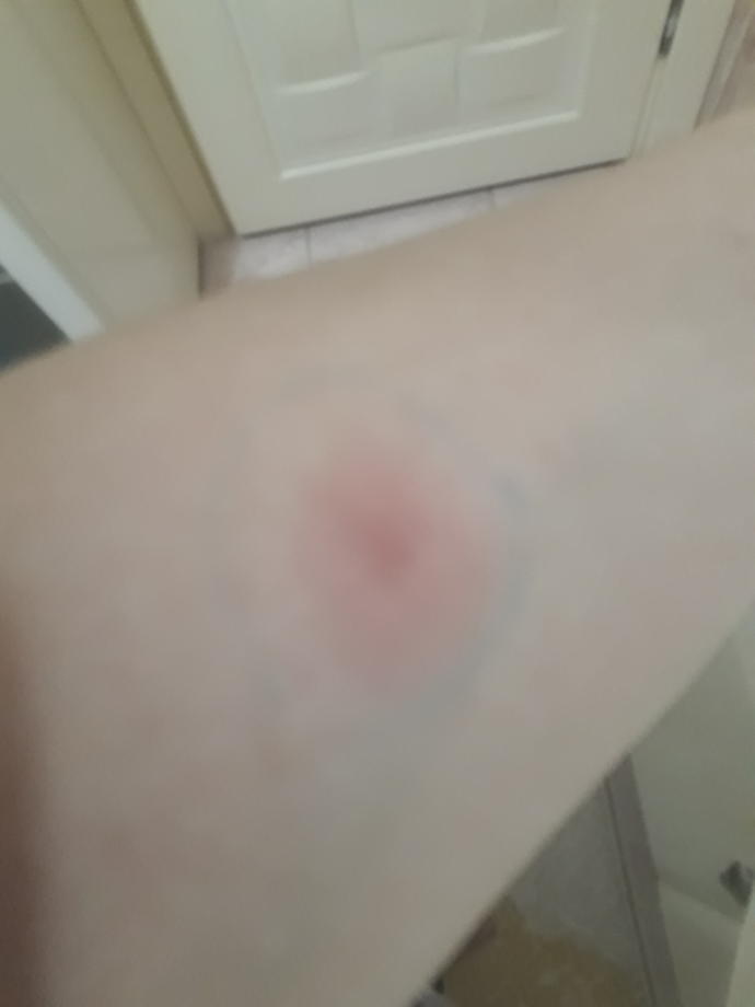 Verem deri testi hakkinda bilgisi olan varmi?