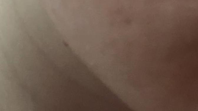 Acnelyse kullanıyorum 2.5 ayı geçti. Dün yüzümü kaşıdım tırnaklarımla ve yüzümde bunlar çıktı. Komedinin mu?