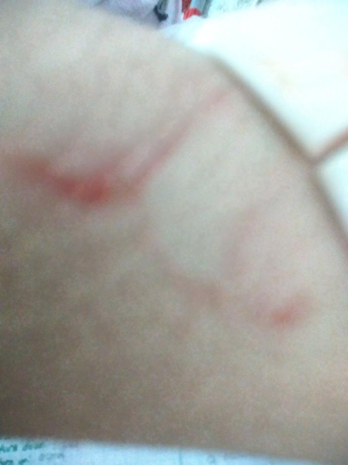 Kolumdaki yara ciddi mi? Nasıl geçer?