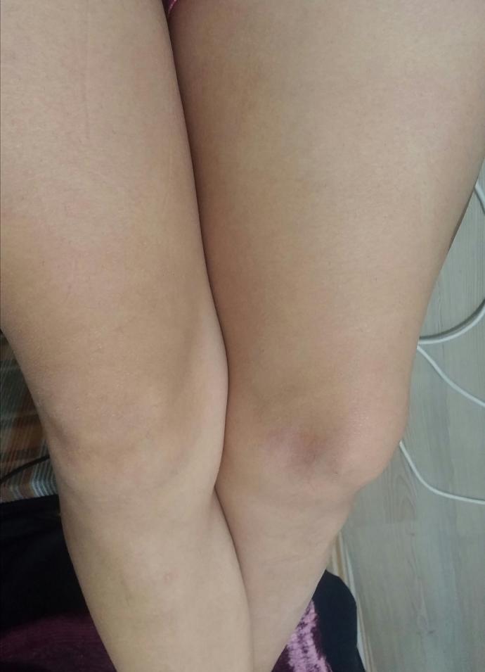 Bacak Kıllarımı Aldırdım Pişmanım smdmdıdmsn?