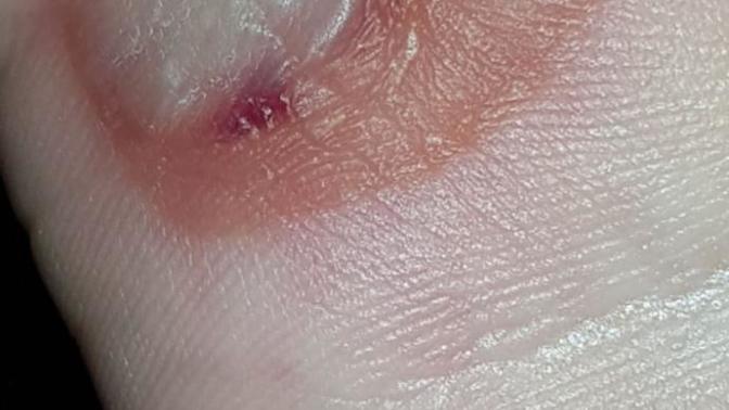 Elimi yakmıştım su topladı ve şimdi bu hale geldi nasıl geçer niye böyle olur?