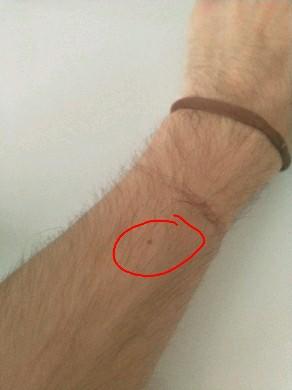 Kadınların bileklerinde ben olması tesadüf mü?
