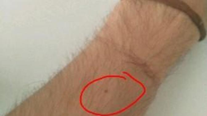 Kadınların bileklerinde ben olması tesadüf mü?