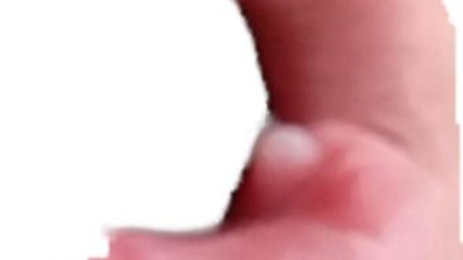 Ağzımın sağ dudak iç kısmında beyaz bir şey cıktı bir türlü gitmiyor ya yok mu bir çözüm?