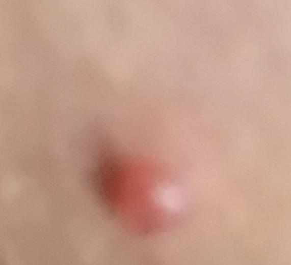 Bacağımın iç tarafında et beni gibi bir şey çıktı ne olduğu hakkında bir fikri olan var mı?