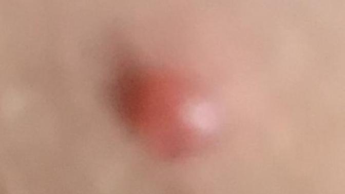 Bacağımın iç tarafında et beni gibi bir şey çıktı ne olduğu hakkında bir fikri olan var mı?