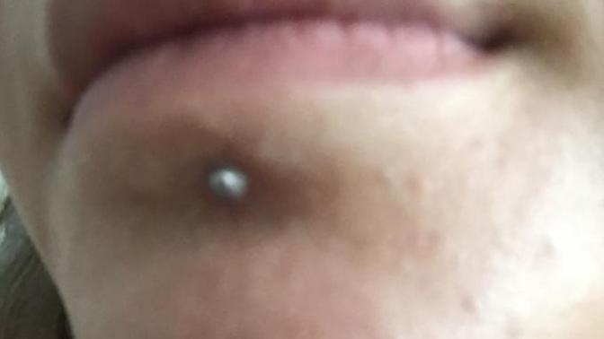 Piercing İltihabı Nasıl Geçer?