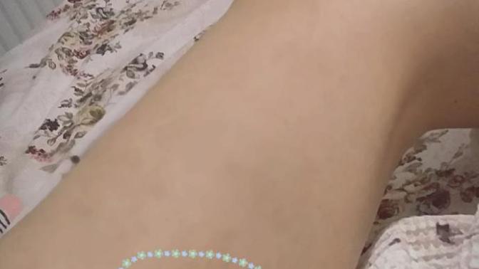 Bacağımdaki bu morluk geçmiyor ne yapıcam yardım?