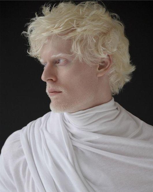 Albino erkek 