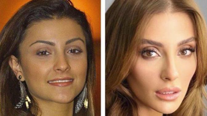 Özge Ulusoy'un estetiksiz fotoğrafı ortaya çıktı.. Estetik yapılmadan önceki halini beğendiniz mi?
