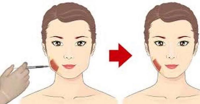 Masseter botoksu yaptıran var mı?