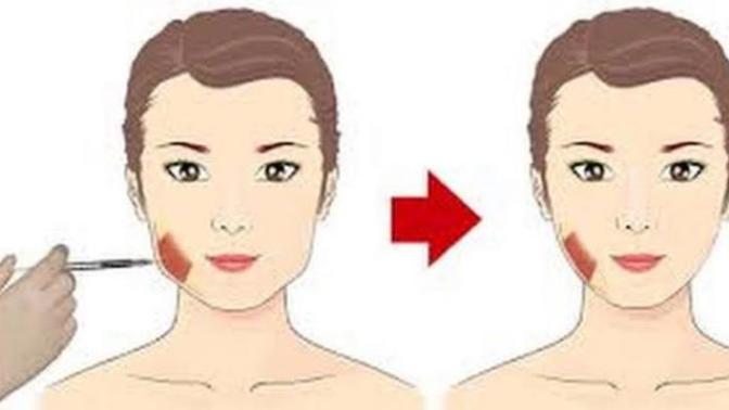 Masseter botoksu yaptıran var mı?