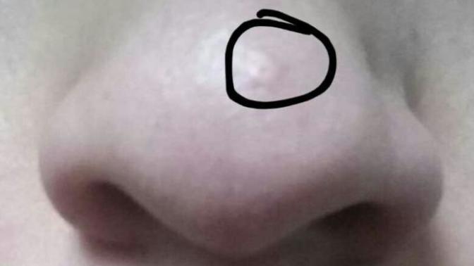 BURUNDA SİVİLCE İZİ?