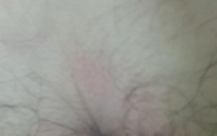 Popomda Kıl Dönmesi mi Çıkıyor?
