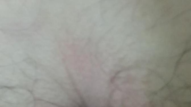 Popomda Kıl Dönmesi mi Çıkıyor?