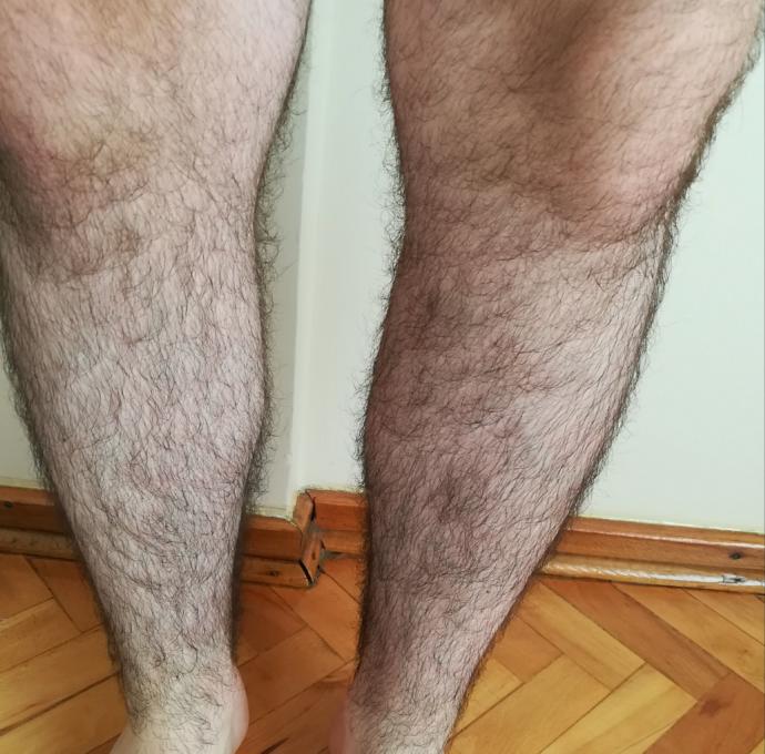 Bacak kıllarım yoğun, kötü görüntü olur diye bu sıcaklarda pantolon ile pişiyorum. Sizce çok mu yoğun, erkek için normal mi?