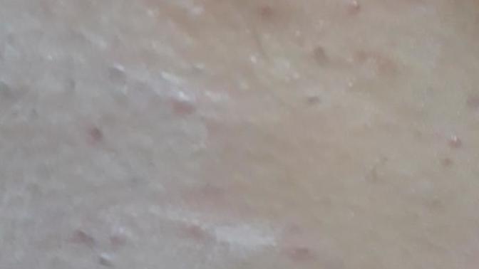 Genital bölgedeki kıl köklerinde kızarıklık?