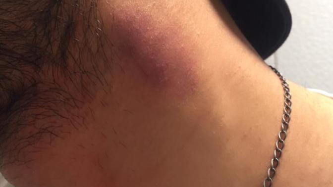 Boynum çok morarmışmı?