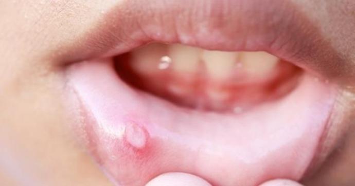 Ağzımda aft varken sevgilime oral yaptım ve öpüştüm. Mikrop mu aldık?