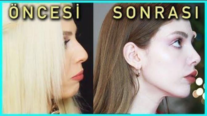Çenesinde selülit olduğunu düşünen ve çözümünü bulan var mı?