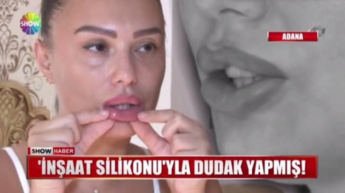Bu ara kadinlarda manda dudaği modasi mi var? Silikonu sıktıran orangutan gibi geziyor yahu. Fazla kalin dudak çekici mi sizce?