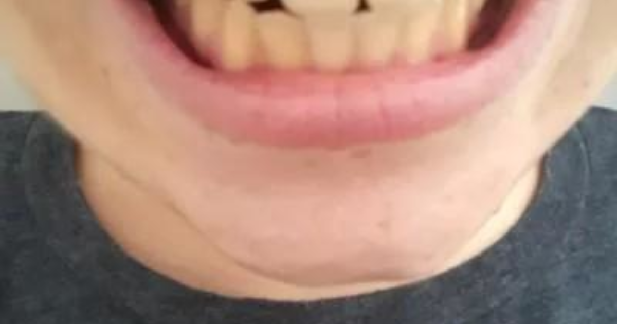 dislerim yuzunden bulusmaya korkuyorum kizlarsoruyor