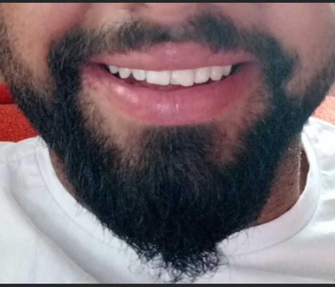 Sıra dışı görünmek isteyenlerin tercihi olan diş eti piercingi hakkında ne düşünüyorsunuz?