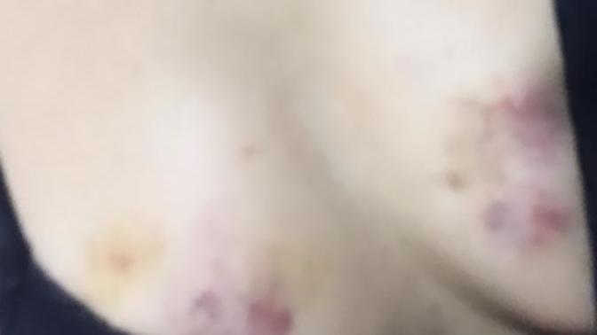 Bu aşk ısırığı nasıl geçer?